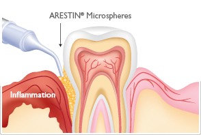 periodontal gum disease treatment