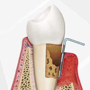 Tucson Tooth Pocket Reduction