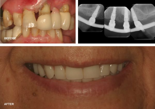 Before and After close up of dental implant procedure