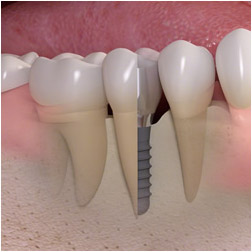 Dental implant diagram from Southern Arizona Periodontics.