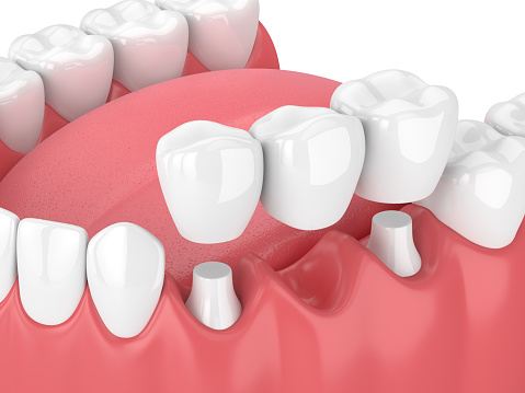 Dental bridge diagram to replace missing teeth