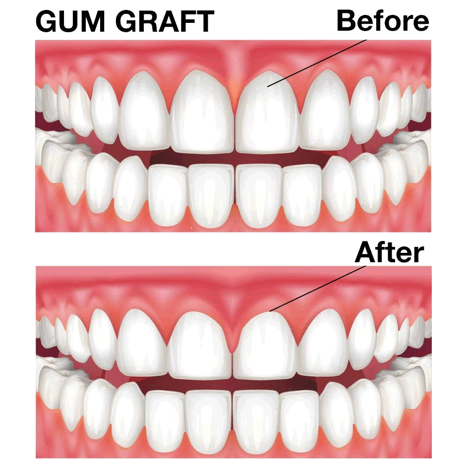 Dental Dos And Donts After Gum Graft Surgery Tucson Periodontist