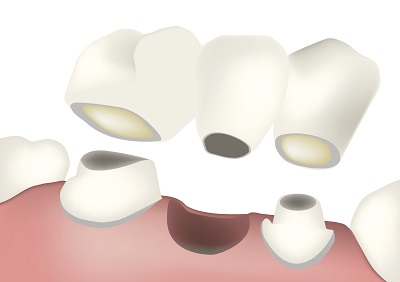 How a Dental Bridge Could Help With Gum Disease Treatment