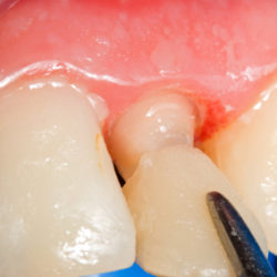 Dangers of Not Taking Care of Dental Veneers