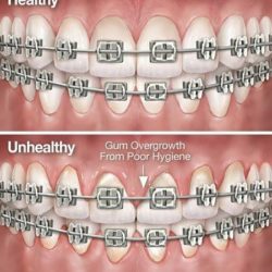 How braces might affect gum health.