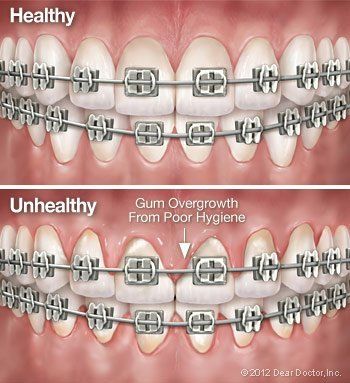 How braces might affect gum health.