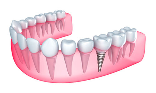 Rendering of a single dental implant in a lower jaw