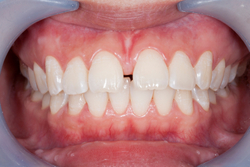 frenectomy before picture of a patient with a gap between the two upper front teeth