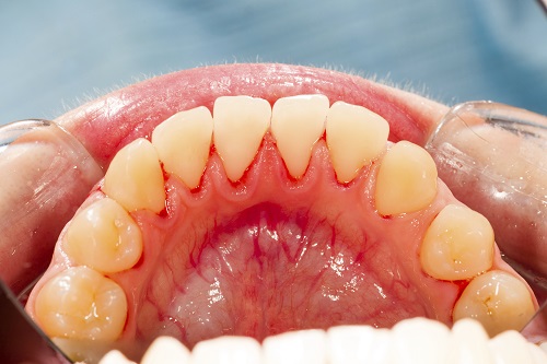 close up of lower jaw teeth and irritated gums gum disease